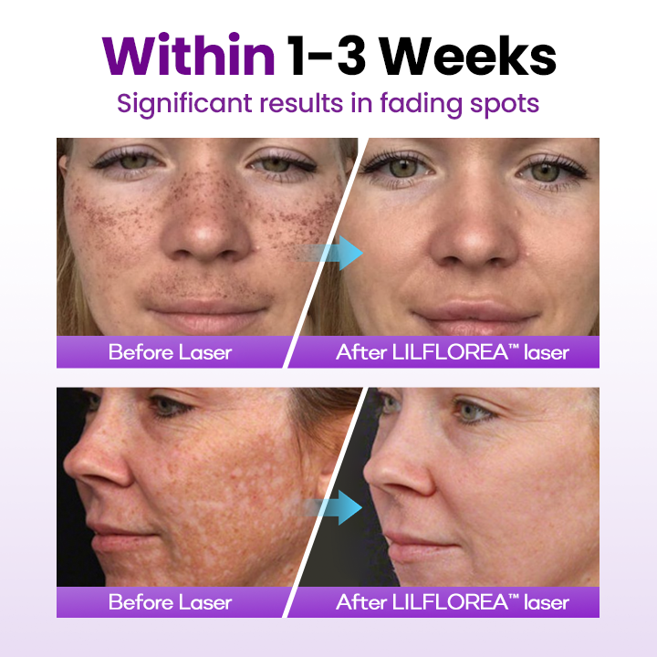 Filflorea® SpotErase Probiotic Shield Serum