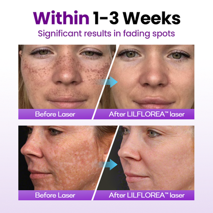 Filflorea® SpotErase Probiotic Shield Serum