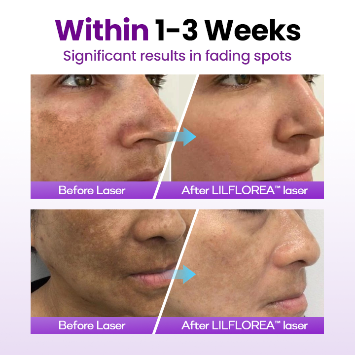 Filflorea® SpotErase Probiotic Shield Serum